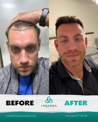 New York, Medical, Trusted Hair Transplant Clinic In Istanbul