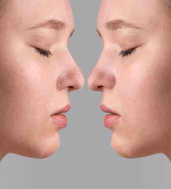 Cape Town, Health, Transform Your Look With Professional Rhinoplasty In Cape Town