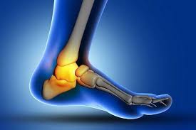 Singapore, Health, Surgery Or Conservative Care For Severe Ankle Ligament Tears