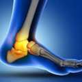 Surgery Or Conservative Care For Severe Ankle Ligament Tears
