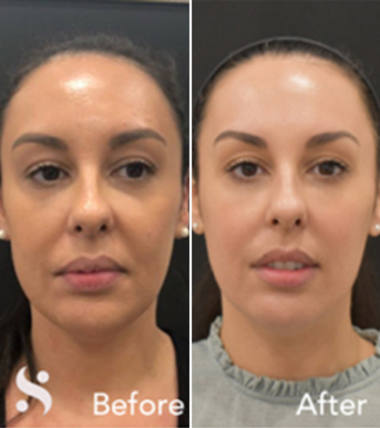 London, Beautician, Transform Your Look With 8 Point Liquid Facelift &ndash; Serenity Aesthetics