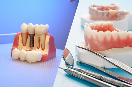Washington DC, Dental, How Long Do Dentures Implants Last?