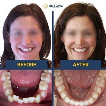 Toronto, Dental, Teen Invisalign In Surrey By Experienced Orthodontist &ndash; Beyond Braces