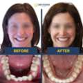 Teen Invisalign In Surrey By Experienced Orthodontist – Beyond Braces