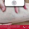 Varicose Veins Treatment In Ahmedabad By Dr.Vatsal Agrawal