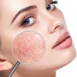 New York, Beautician, What Is The Best Broken Capillaries Treatment Fort Collins Offers?