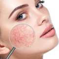 What Is The Best Broken Capillaries Treatment Fort Collins Offers?