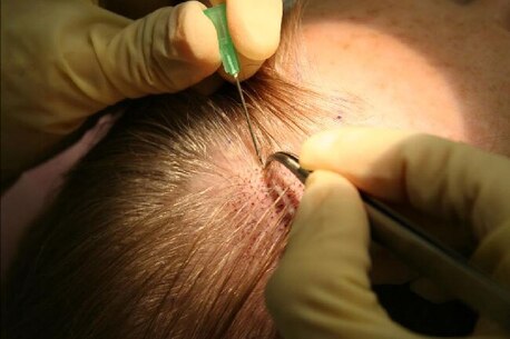 Mumbai, Health, Advanced FUE Hair Transplant In Mumbai | Hair And Shape Clinic