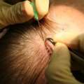 Advanced FUE Hair Transplant In Mumbai | Hair And Shape Clinic