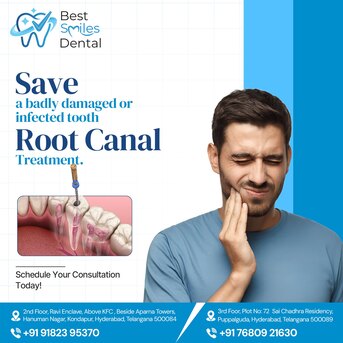 Hyderabad, Dental, Best RCT Treatment In Kondapur -  Best Smiles Dental Clinic, Hyderabad