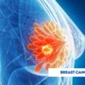 Breast Cancer Treatment In India &ndash; Advanced Care At Affordable Cost With Edhacare
