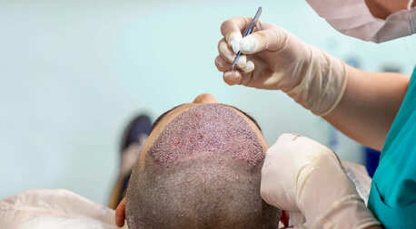 Mumbai, Health, Hair Transplant Surgery In Mumbai With Natural Results