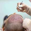 Hair Transplant Surgery In Mumbai With Natural Results