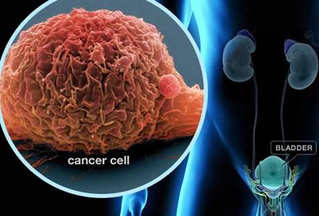 New Delhi, Health, Prostate Treatment In New Delhi