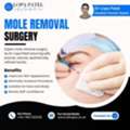 Mole Removal Surgery In UK By Dr Lopa Patel
