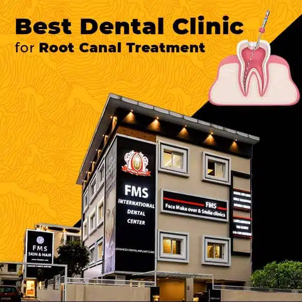 Hyderabad, Dental, Root Canal Treatment In Hyderabad | Expert RCT Specialists