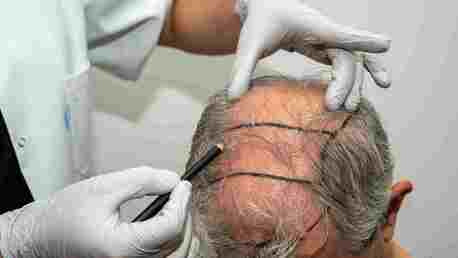 Mumbai, General, Know The PRP Hair Treatment Cost In Mumbai Before You Begin