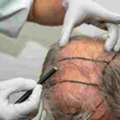 Know The PRP Hair Treatment Cost In Mumbai Before You Begin