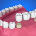 Root Canal Treatment | DentXperts Clinic