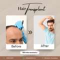 Hair Transplant In Ahmedabad &ndash; Advanced FUE & DHI At Mila Aesthetics