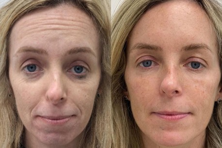 Dublin, Health, Facial Rejuve Dublin