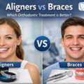 Aligners Vs Braces &ndash; Expert Guide By Dental Peace