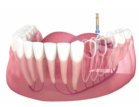 Abu Dhabi, Dental, Pain-Free Root Canal Care You Can Trust