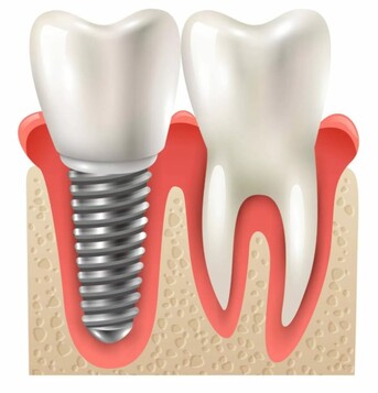 Abu Dhabi, Dental, Dental Crowns That Fit Your Smile &mdash; And Your Budget