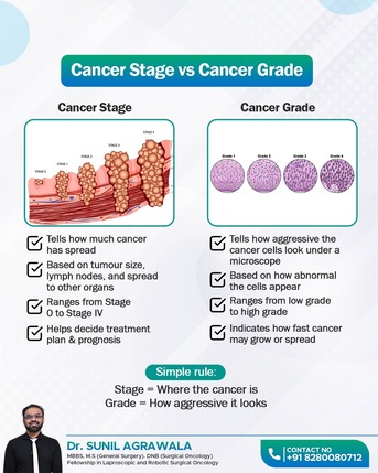 Mumbai, Health, Cancer Stage Vs Grade | Best Oncologist In Bhubaneswar | Dr. Sunil Agrawala