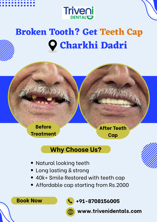 Haryana, Dental, Teeth Cap Treatment In Charkhi Dadri | Triveni Dental