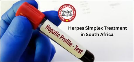 Mumbai, Health, Herpes Simplex Treatment In South Africa