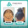 Leading Clinics Specializing In Afro Hair Restoration