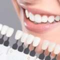 Teeth Alignment Treatment In Panchkula | Dentxperts Clinic