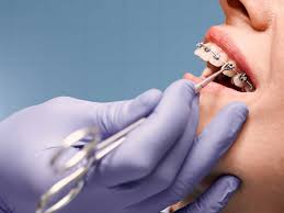 Abu Dhabi, Dental, Teeth Whitening In Abu Dhabi