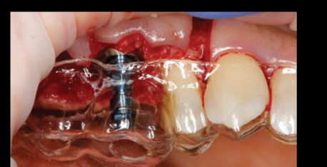 Lucknow, Health, Zygomatic Implant Treatment Noida Sector 135 &ndash; The Dental Port