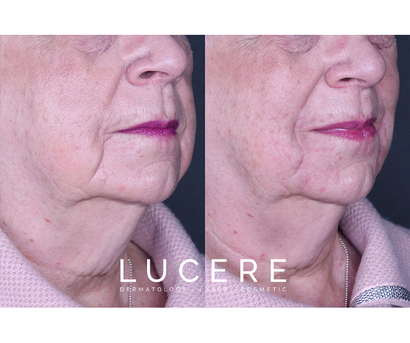 Edmonton, Beautician, Facial Balancing With Filler