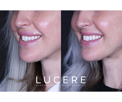 Edmonton, Beautician, Facial Balancing With Filler