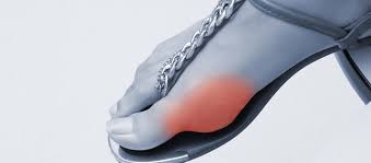 Singapore, Health, 5 Benefits Of Essential Bunion Care Services