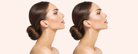 Mumbai, Health, How Long Does A Nose Job Take To Heal?