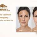 Melasma Treatment Homeopathy: Causes, Remedies, And Natural Care