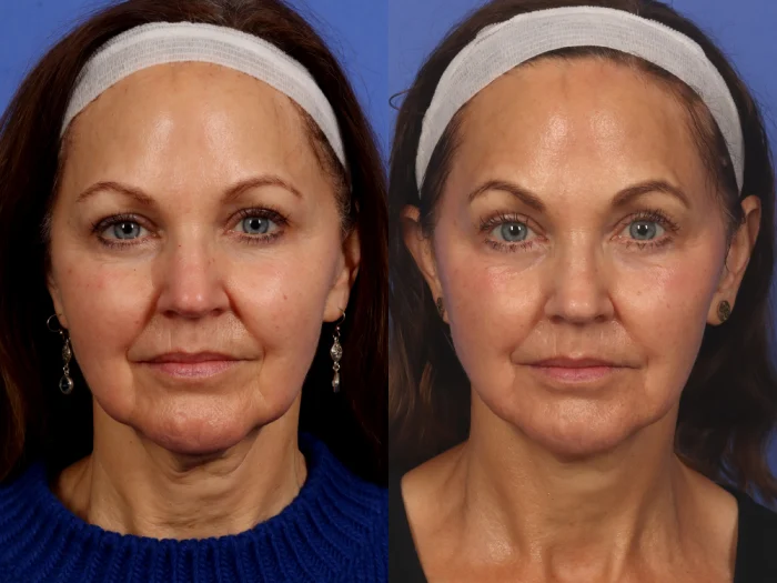 Dubai, Health, Morpheus8 Dubai &ndash; Advanced RF Microneedling For Skin Tightening & Lifting