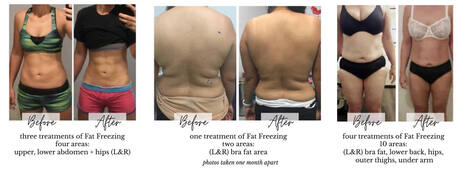 Sydney, Business, Fat Freezing Near Gold Coast &ndash; Miami Kiss International