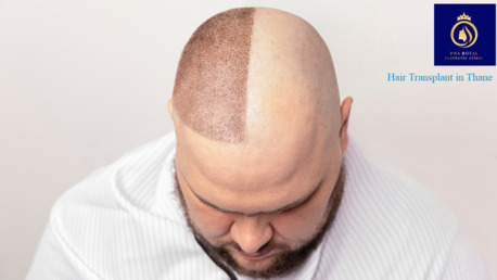 Mumbai, Health, Best Hair Transplant Clinic In Thane At DNA Royal |Understanding Modern Hair Restoration