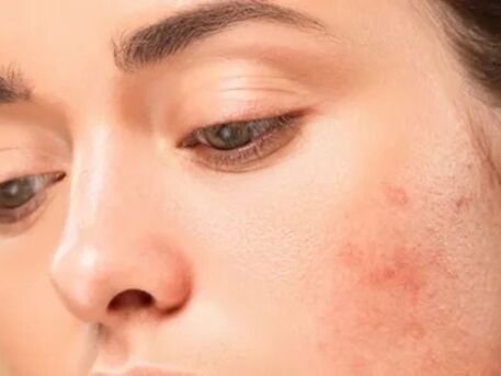 New York, Business, Acne Scars Near Me | Advanced Skin Treatments In CA