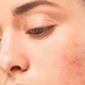 Acne Scars Near Me | Advanced Skin Treatments In CA