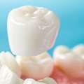 Dental Crowns Port Macquarie &ndash; Expert Smile Restoration Care