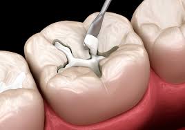 London, Dental, Natural-Looking Fillings St Albans | 01727 853160 | St. Peter