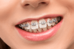 Bangalore, Dental, Traditional Braces Treatment &ndash; Orthodontic Care In Bangalore