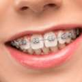 Traditional Braces Treatment &ndash; Orthodontic Care In Bangalore
