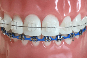 Bangalore, Dental, Traditional Braces Treatment &ndash; Orthodontic Care In Bangalore